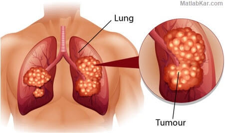 تصویر diagnosis-pathologic-lung-cancer-data-mining_1893_2 تشخیص مرحله بندی پاتولوژیکی سرطان ریه با روش های داده کاوی