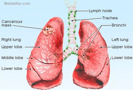 تصویر diagnosis-pathologic-lung-cancer-data-mining_1893_3 تشخیص مرحله بندی پاتولوژیکی سرطان ریه با روش های داده کاوی