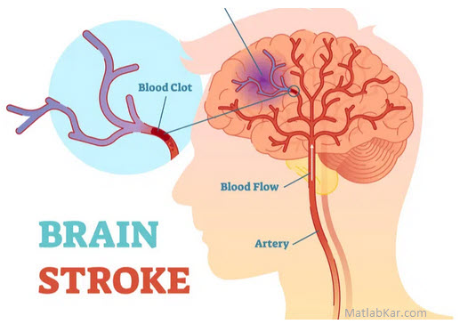 تصویر stroke-diagnosis-k-means-matlab_3544_1 تشخیص سکته مغزی با قطعه بندی تصاویر MRI توسط الگوریتم K Means در متلب